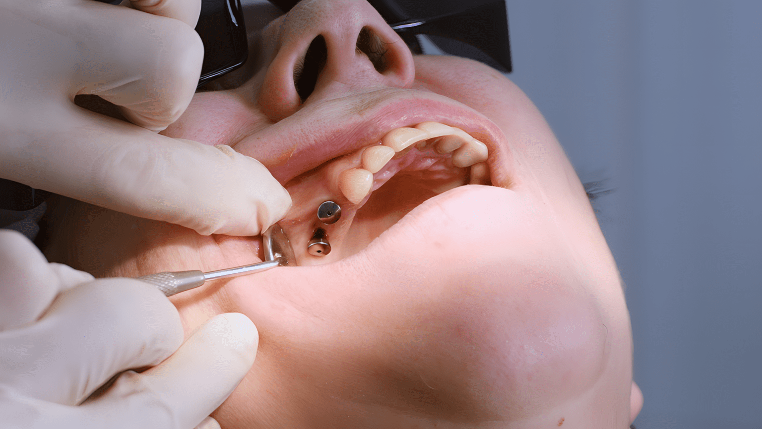 Pickering dental implants