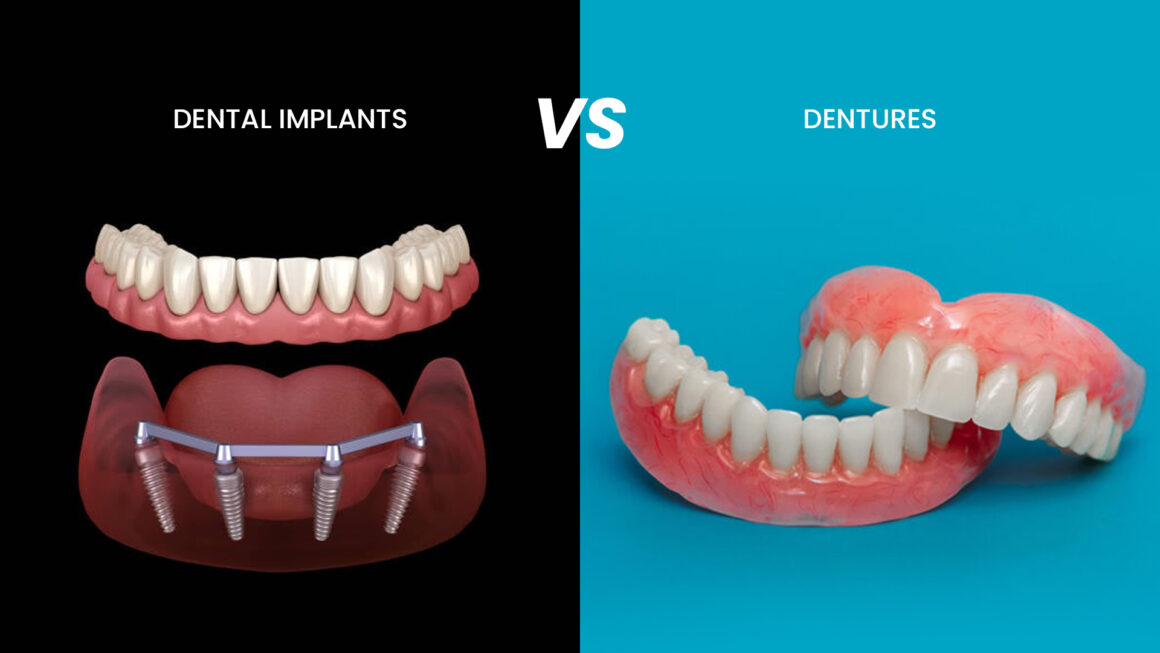 Dental Implants vs Dentures_ Which Is Better for You Dental Implants vs Dentures_ Which Is Better for You