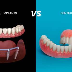 Dental Implants vs Dentures_ Which Is Better for You