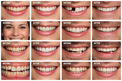 dental implants services