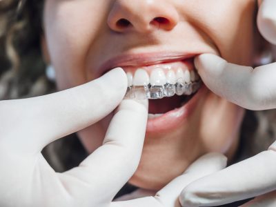Doctor putting a clear dental aligner to the patient woman